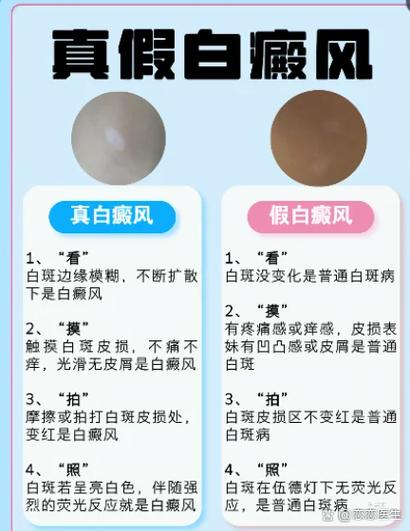 如何判断白斑是不是白风